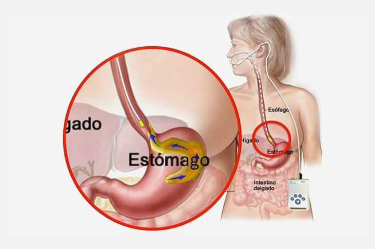 Gastroendo Rio de Janeiro RJ Gastroenterologia Exames Manometria Esofágica pHmetria Esofágica