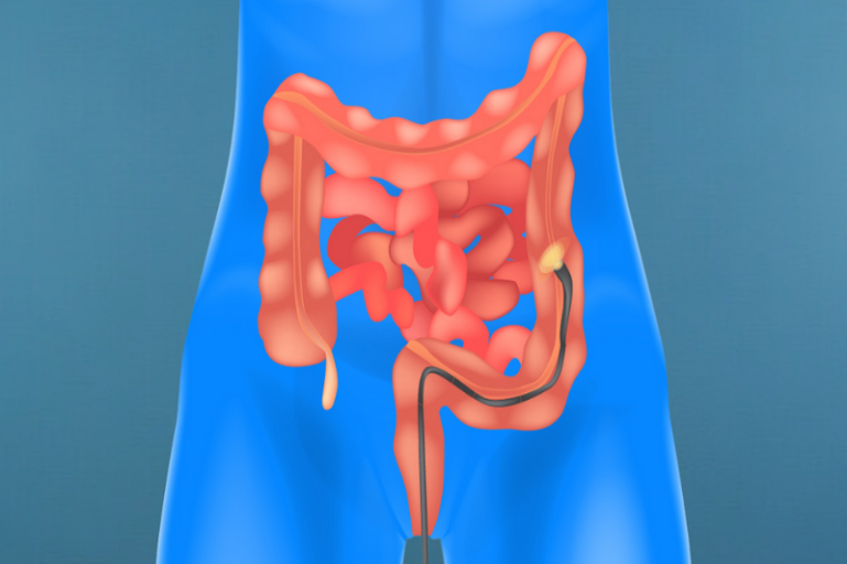 Gastroendo Rio de Janeiro RJ Gastroenterologia Exames Retossigmoidoscopia Flexível